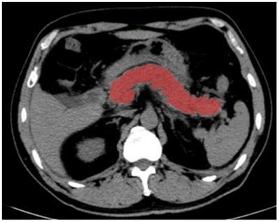 The value of CT-based radiomics in predicting the prognosis of acute pancreatitis